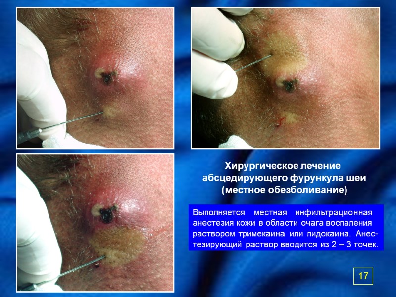 Хирургическое лечение  абсцедирующего фурункула шеи (местное обезболивание) Выполняется   местная  